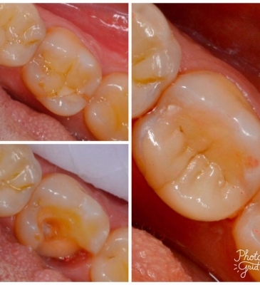 Invisible restorations with Inlay EMax