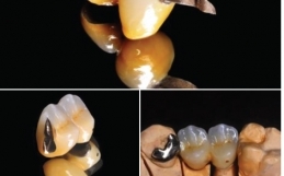 Gold ceramic bridge. Sanding minimally invasive – Aesthetics