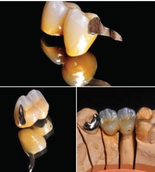 Gold ceramic bridge. Sanding minimally invasive – Aesthetics